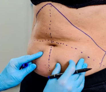 Understanding Tummy Tuck Surgery with TrustMed Clinic
