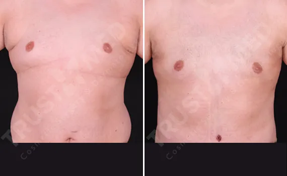 Tummy Tuck For Men