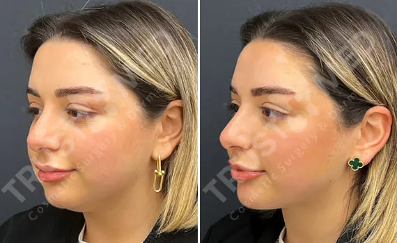 Double Chin Liposuction