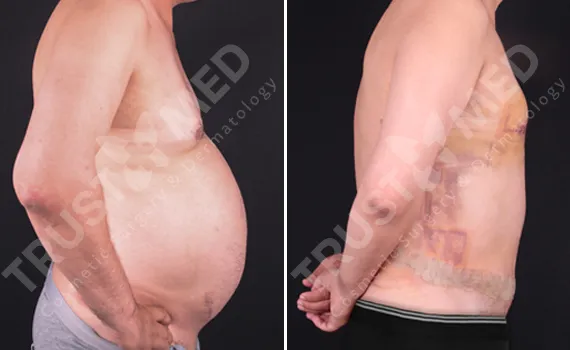 Tummy Tuck for Men