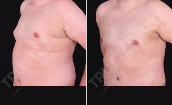 Tummy Tuck For Men