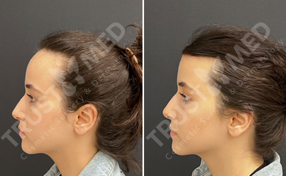 Forehead Reduction
