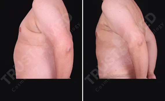 Tummy Tuck For Men