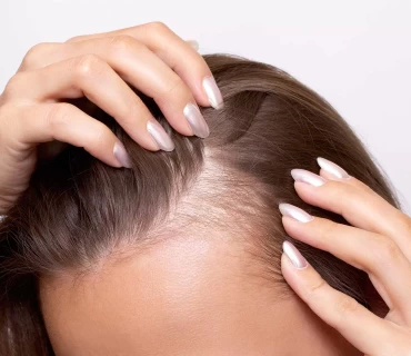 A Guide to Female Hair Transplants in Turkey: Restoring Confidence and Volume