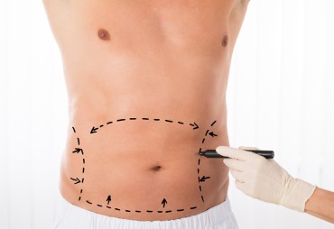 A Man's Guide to Abdominal Transformation: Tummy Tuck Surgery in Turkey