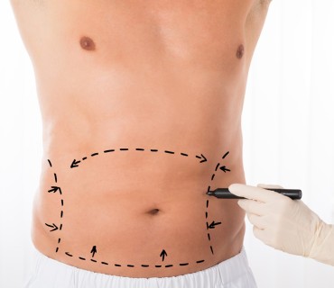 A Man's Guide to Abdominal Transformation: Tummy Tuck Surgery in Turkey
