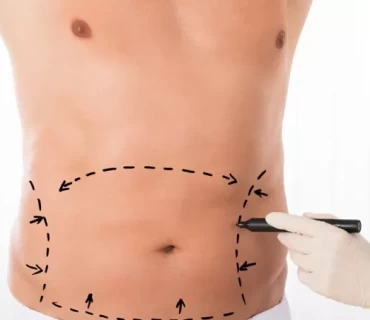 A Man's Guide to Abdominal Transformation: Tummy Tuck Surgery in Turkey