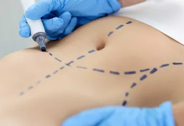 Abdominoplasty Facts: Common Questions Answered