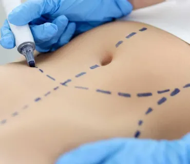 Abdominoplasty Facts: Common Questions Answered