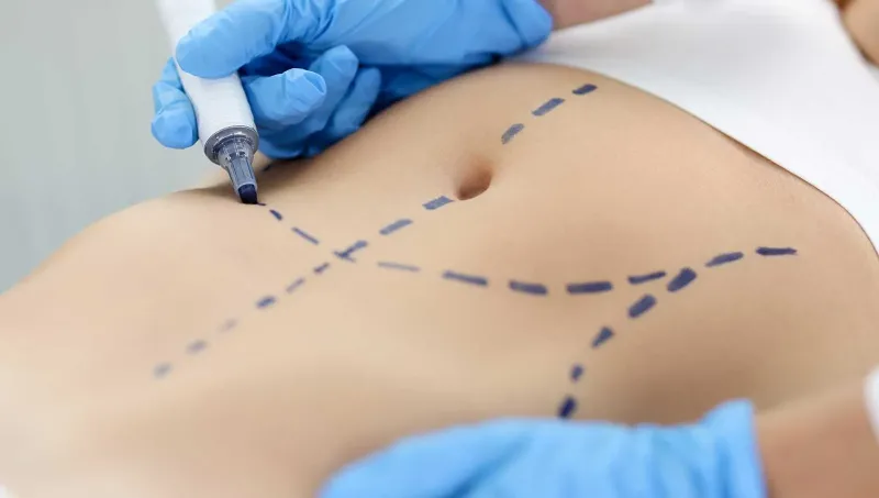 Abdominoplasty Facts: Common Questions Answered