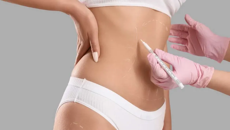 All About Extended Abdominoplasty: Who Needs It Most?