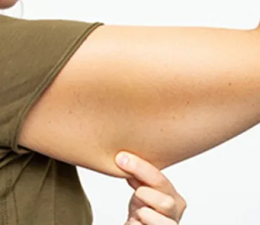 Arm Lift