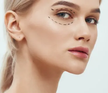 Blepharoplasty(Upper Eyelid Surgery)
