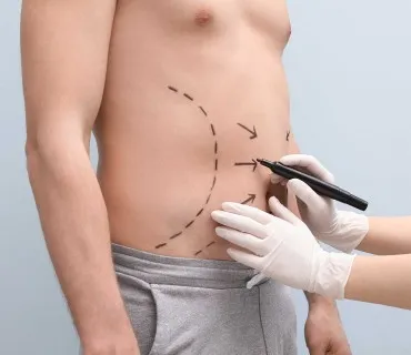 Defining Dad Bods: Exploring Liposuction for Men in Turkey