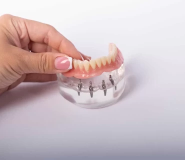 Everything You Need to Know About All-on-Four Dental Implants