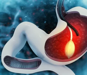 Exploring Gastric Balloon Procedures: Your Complete Guide in Turkey