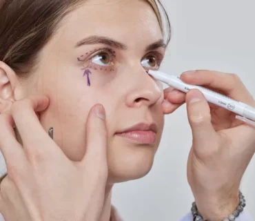 Eye-Catching Trends: The Evolution and Popularity of Fox Eye Surgery