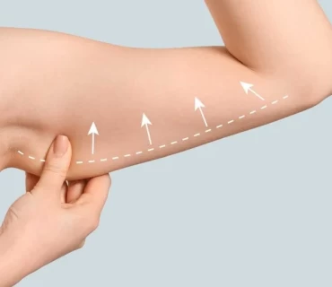 From Flab to Fab: Achieving Toned Arms with Arm Lift Surgery in Turkey