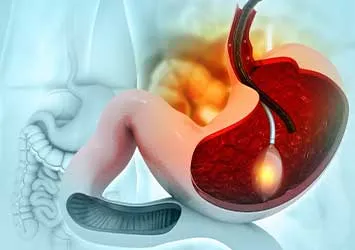 Gastric Balloon