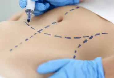 How Long Does Abdominoplasty Recovery Take?