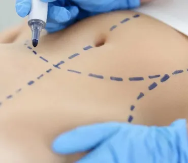 How Long Does Abdominoplasty Recovery Take?
