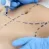 How Long Does Abdominoplasty Recovery Take?