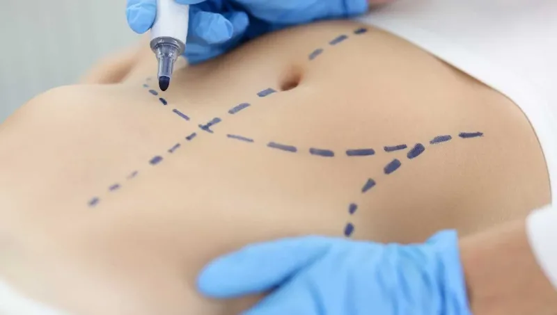 How Long Does Abdominoplasty Recovery Take?