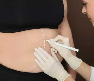 Inspiring Bariatric Surgery Success Stories