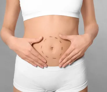 Is Mini Tummy Tuck Right for You?