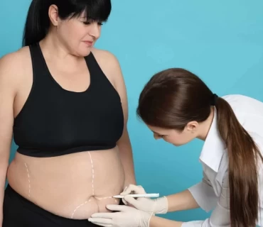 Life After Bariatric Surgery