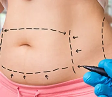 Liposuction