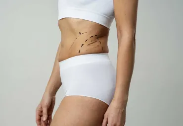 Liposuction: Understanding the Basics