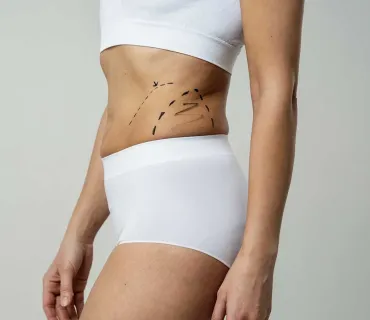 Liposuction: Understanding the Basics