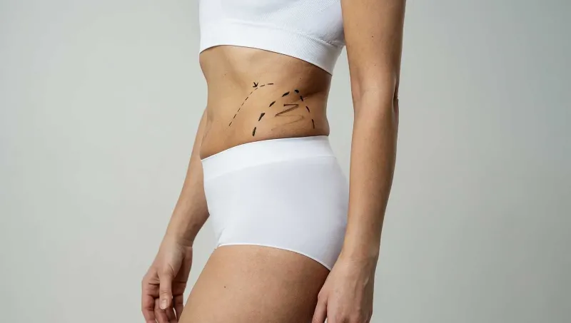 Liposuction: Understanding the Basics