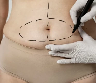 Mommy Transformation: Mummy Makeover Surgery in Turkey Explained