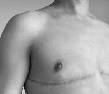Non-Binary Breast Reduction: A Guide to the Procedure and Its Benefits
