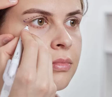 Preparing for Lower Blepharoplasty: Tips for a Smooth Surgery and Recovery