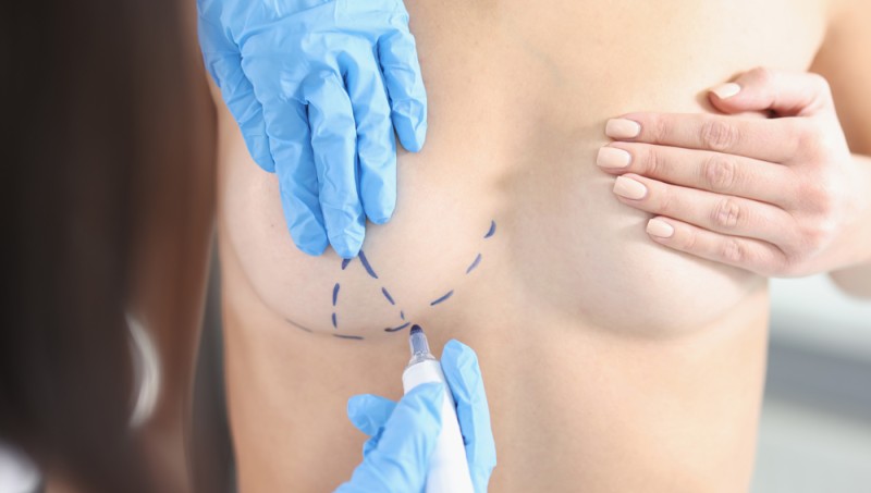 Regain Your Youthful Contours: Exploring Breast Lift Options in Turkey
