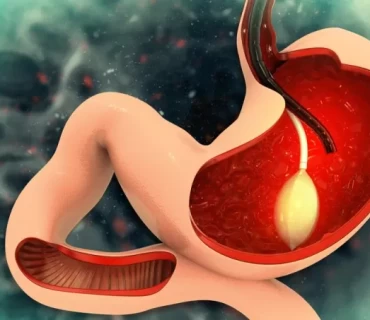 Revolutionizing Weight Loss: Gastric Balloon's Edge Over Other Non-Surgical Methods