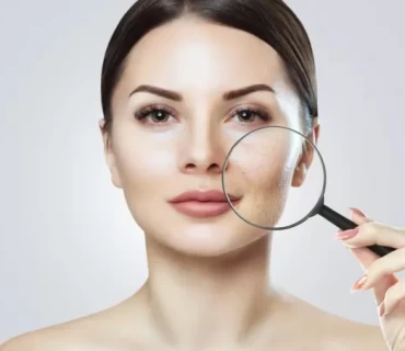 Say Goodbye to Scars: The Top Acne Scar Treatments Revealed