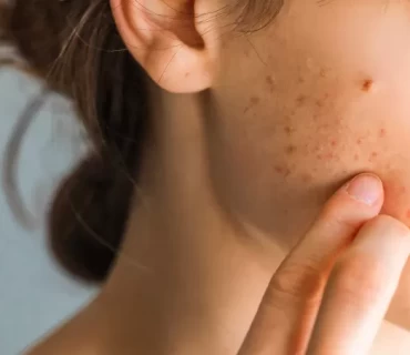 Scarred for What? Understanding Acne Scar Types and Treatment Strategies