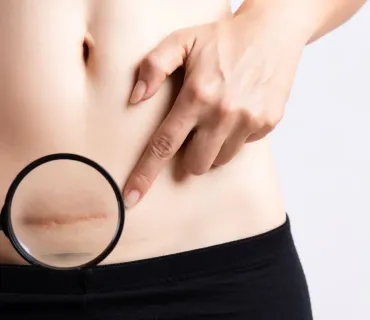 Scarring After Plastic Surgery in Turkey: How to Reduce It