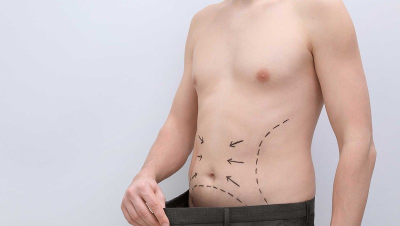 Sculpting Masculinity: Liposuction for Men in Turkey