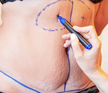 Tummy Tuck (Abdominoplasty)