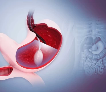 What Is Allurion Gastric Balloon?