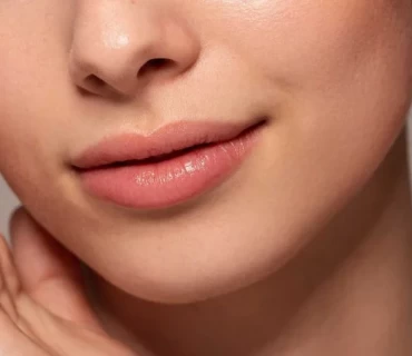 Which One To Choose Lip Lift vs. Lip Fillers