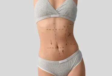 Your Step-by-Step Abdominoplasty Preparation Checklist