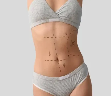 Your Step-by-Step Abdominoplasty Preparation Checklist